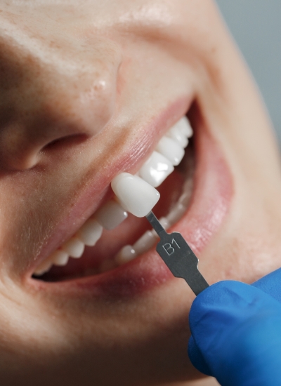 Dental Implants