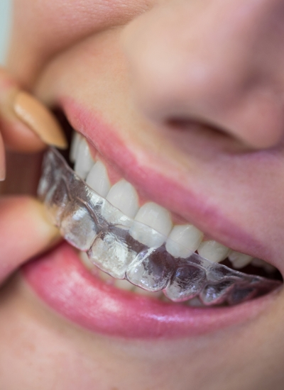 Teeth Straightening